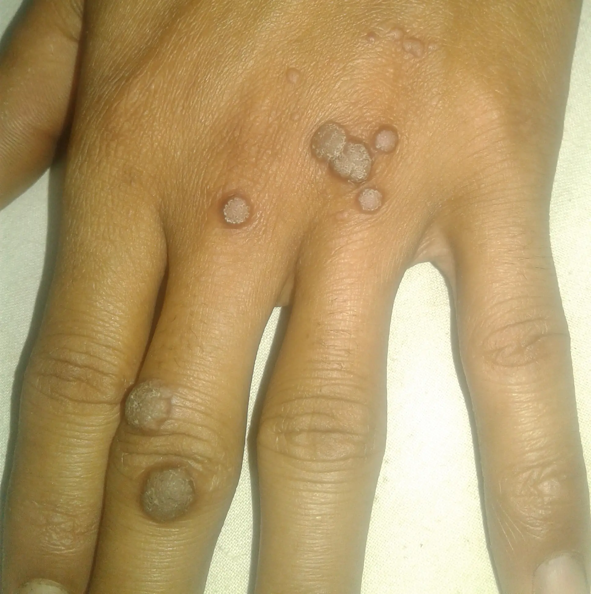 আঁচিল এর হোমিওপ্যাথিক চিকিৎসা ও ওষুধ