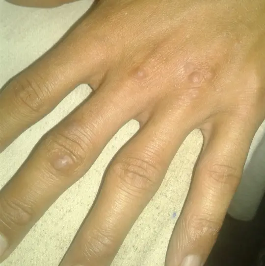 আঁচিল এর হোমিওপ্যাথিক চিকিৎসা ও ওষুধ