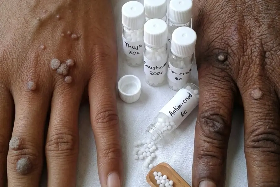 আঁচিল এর হোমিওপ্যাথিক চিকিৎসা ও ওষুধ